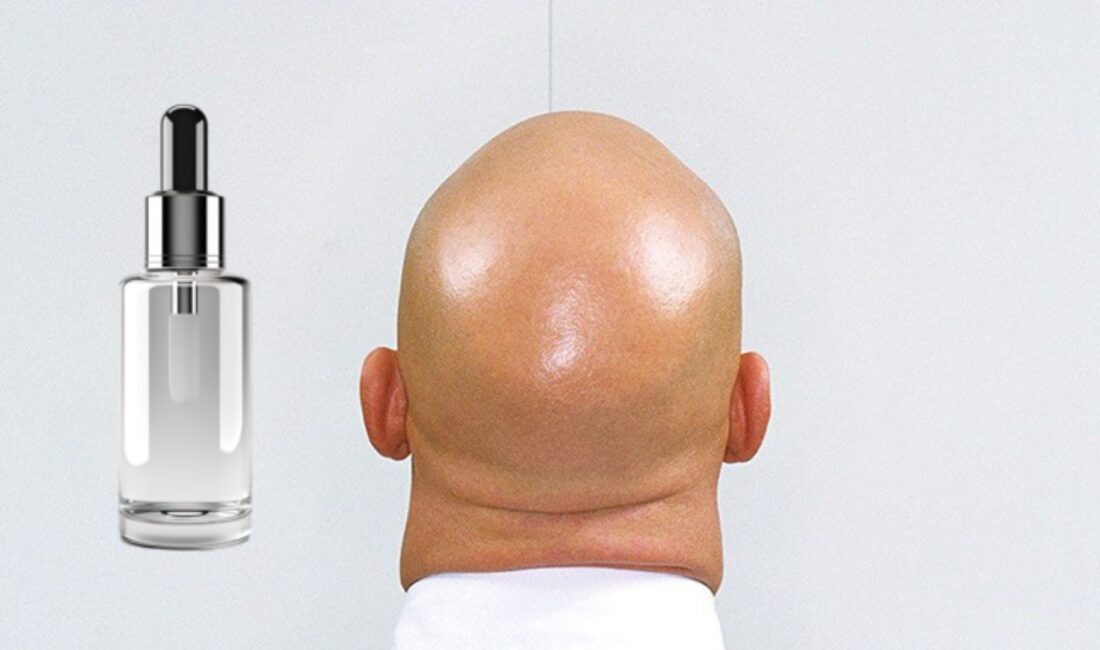 İrlanda menşeili bir ilaç firmasının erkek tipi saç dökülmesi üzerine