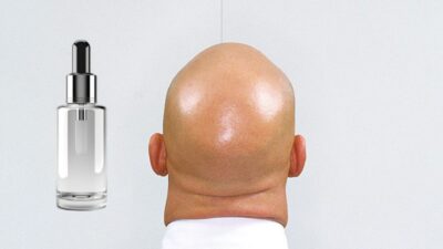 İrlanda menşeili bir ilaç firmasının erkek tipi saç dökülmesi üzerine