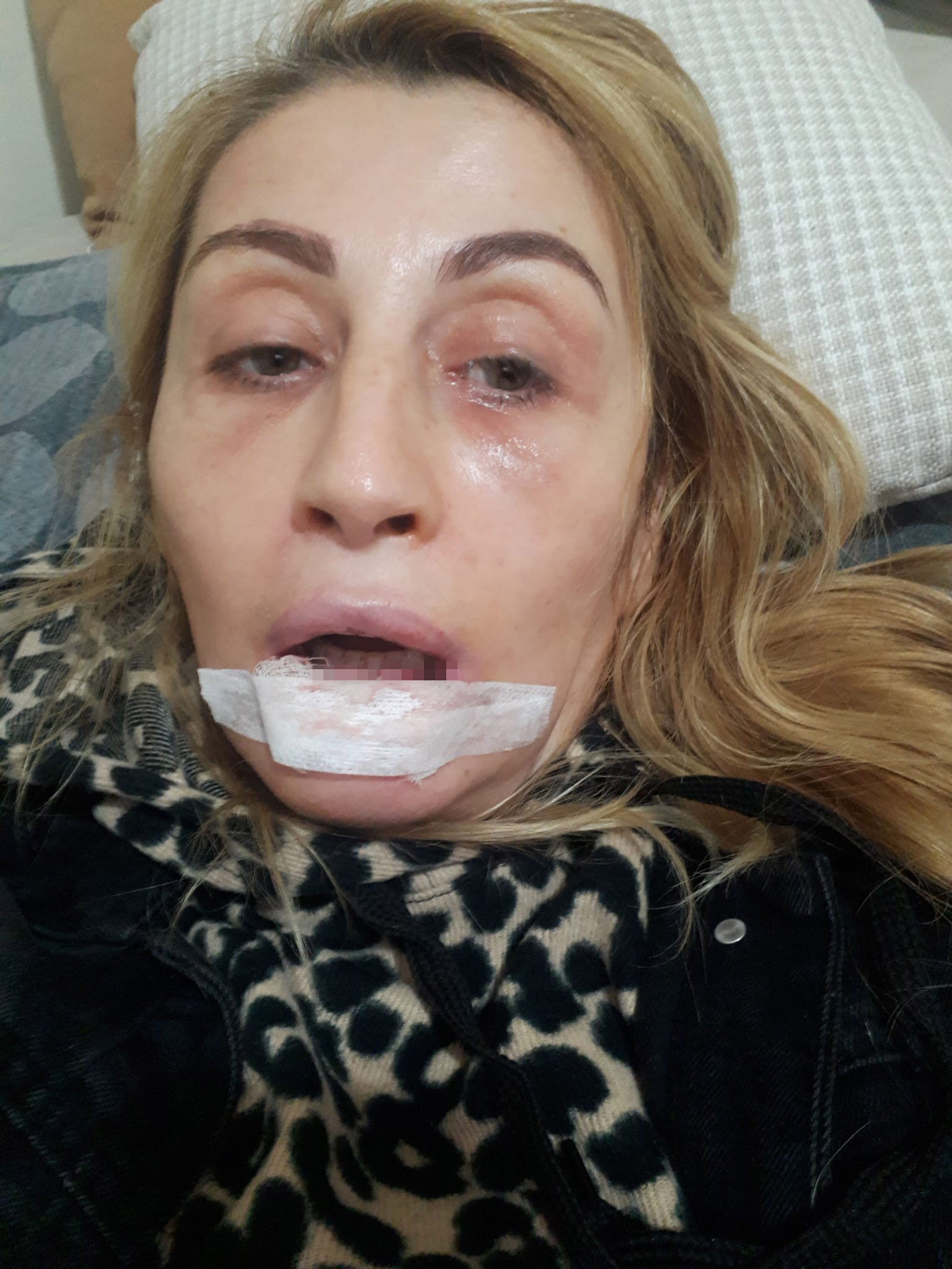 Estetik işlem sonrası dudağı çürüdü