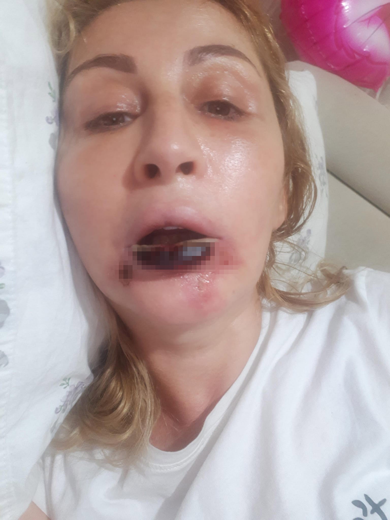 Estetik işlem sonrası dudağı çürüdü
