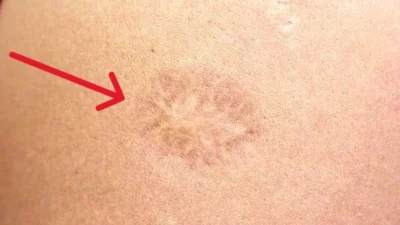 Çocukluk döneminden kalan aşı izleri arasında en belirgin olanı, hemen