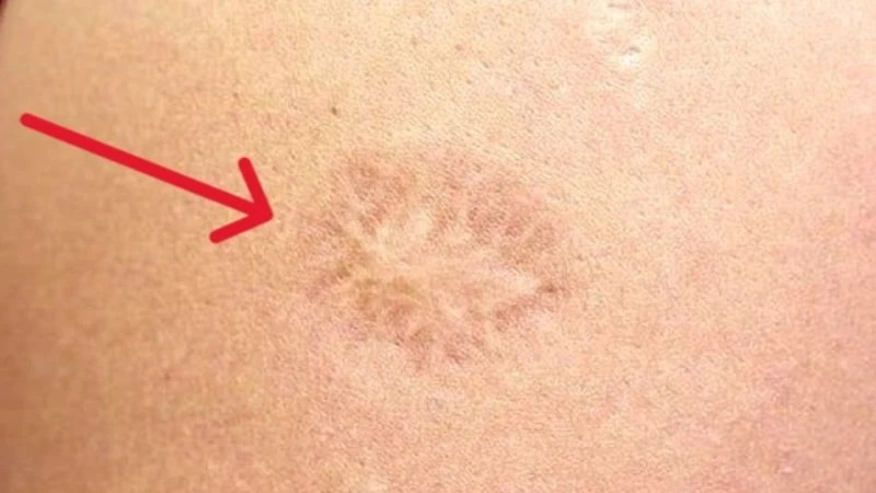 Çocukluk döneminden kalan aşı izleri arasında en belirgin olanı, hemen